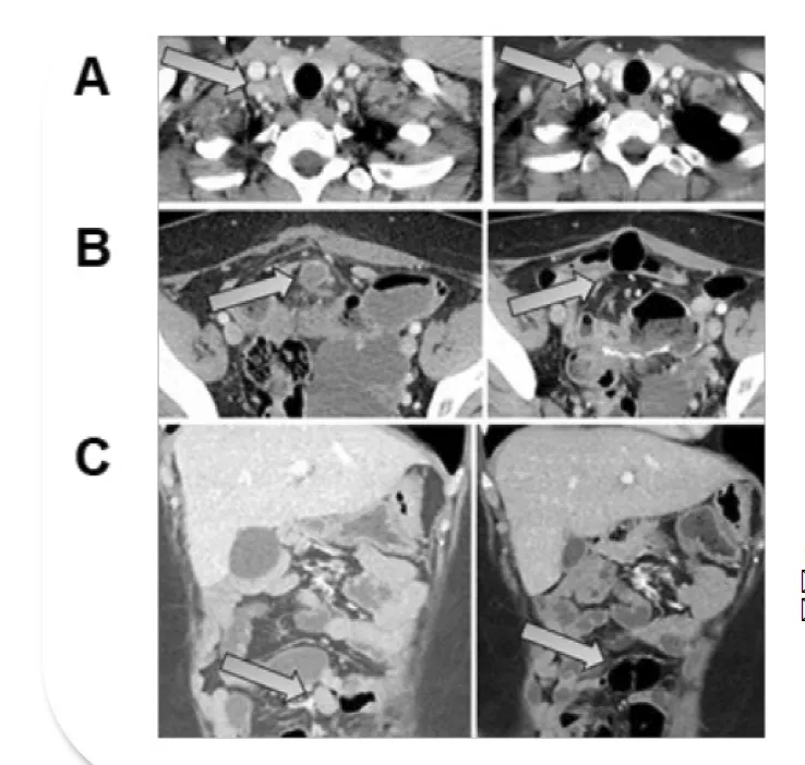CRISPR-TIL治疗结直肠癌的效果