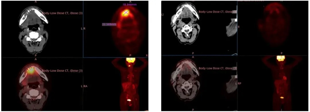 GT201治疗头颈鳞癌的效果