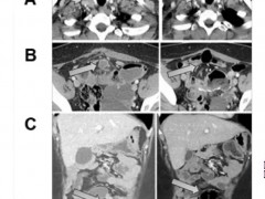 国研TIL疗法GT307获FDA新药临床试验批准，另附2025六大TIL细胞疗法，重创肝癌/肺癌/胰腺癌/肠癌等