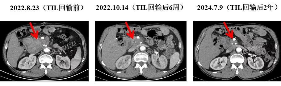 GC101治疗胰腺癌的效果