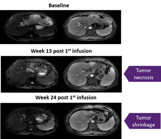 FAST-TIL治疗黑色素瘤的数据