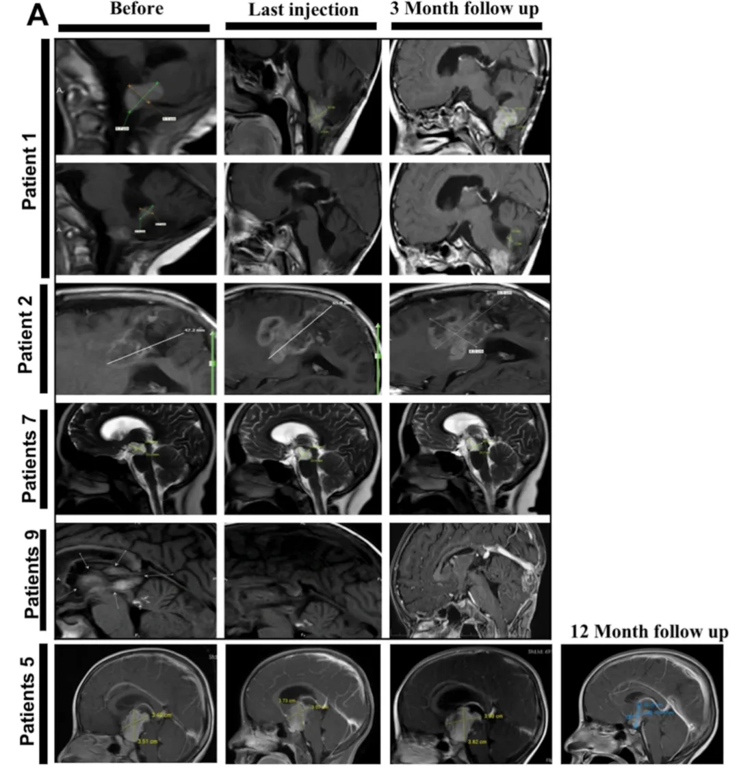 异基因NK细胞疗法治疗胰腺癌的生存期数据
