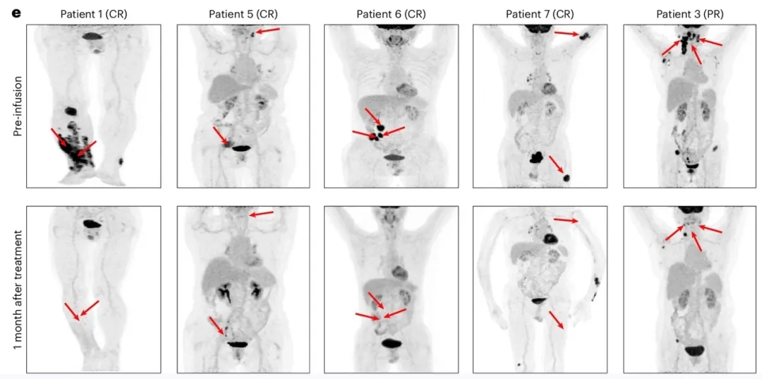 CD19-BBz CAR-NK细胞疗法治疗淋巴瘤的数据