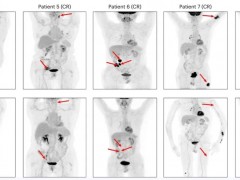 盘点2025年CAR-NK细胞疗法四大重磅进展，MRD-CR率100%满分领跑，缓解率创新高