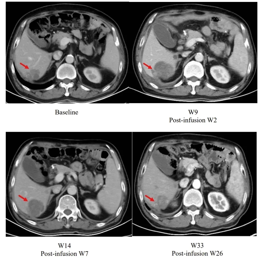 舒瑞基奥伦塞治疗胃癌的效果