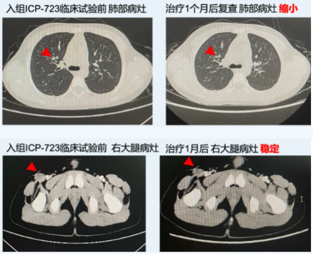 佐来曲替尼治疗软组织恶性梭形细胞肿瘤的效果