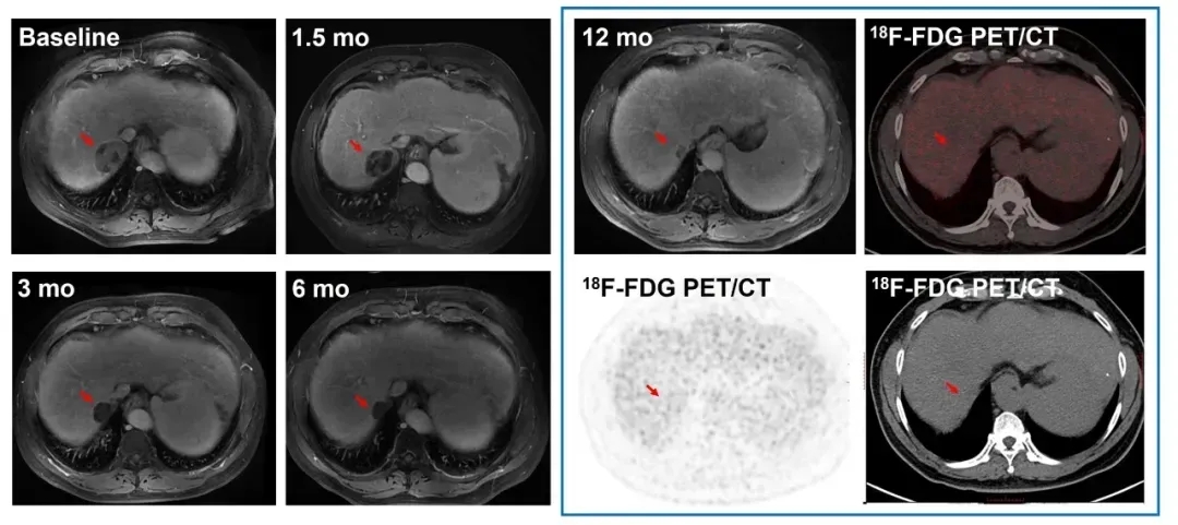 CAR-T治疗肝癌的效果