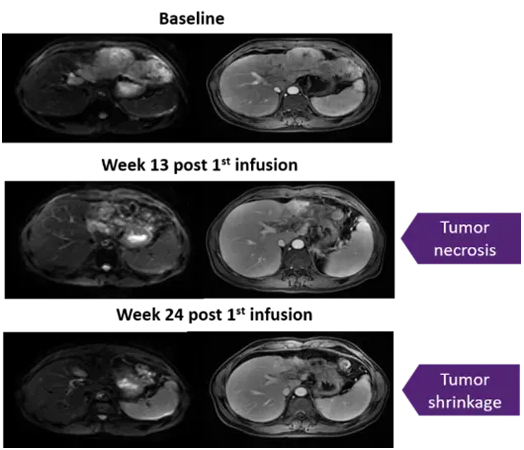Liocyx-M004治疗肝癌的数据