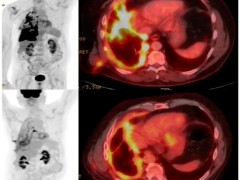 一场与“死神”的告别：CART细胞疗法帮生存不足两个月的患者逆转至完全缓解，多癌种同步告捷