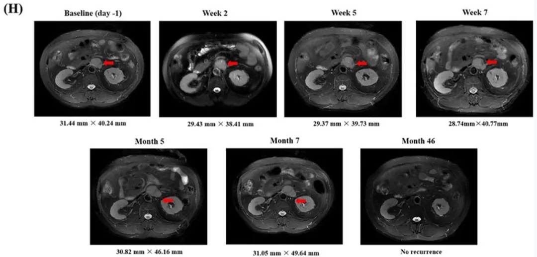 GPC3 CART细胞疗法治疗肝癌的效果 GPC3 CART细胞疗法治疗肝癌的效果