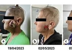 恩曲替尼胶囊(Entrectinib,Rozlytrek)效果怎么样，这些患者可申请免费用药