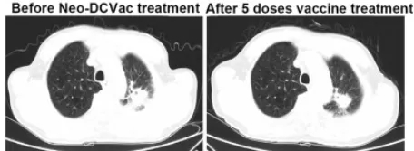 Neo-DCVac疫苗治疗肺腺癌的效果