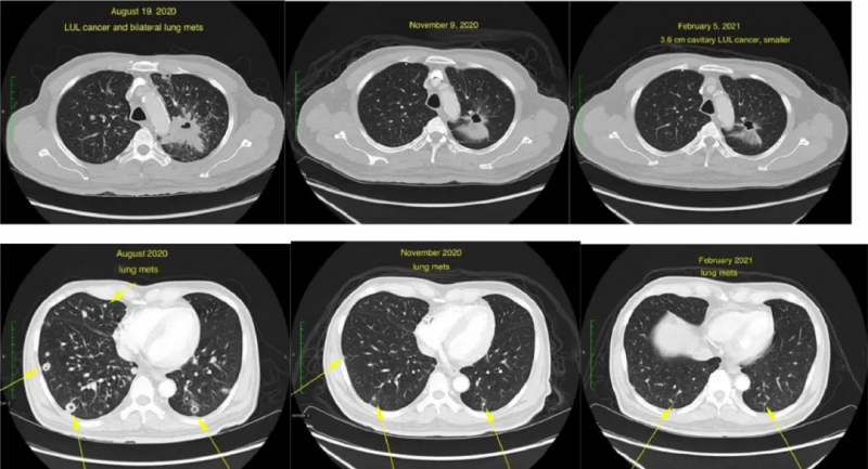 拉罗替你治疗肺癌的效果