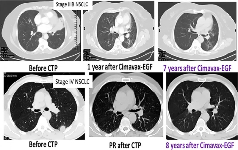 古巴肺癌疫苗治疗数据