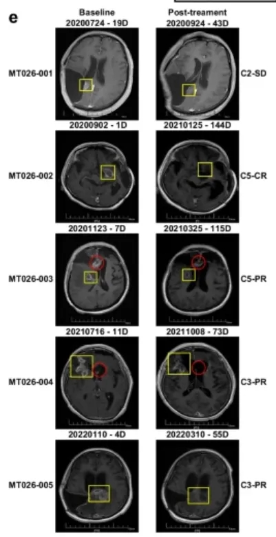 CAR-T细胞疗法MT026治疗高级别胶质瘤的效果