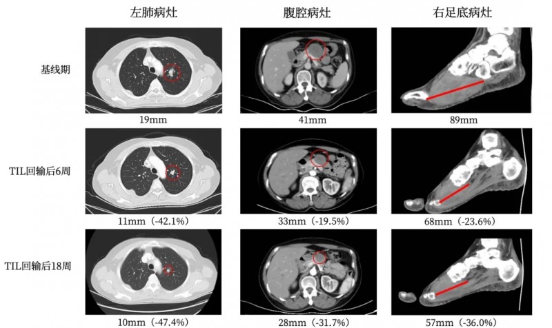 TIL细胞疗法治疗黑色素瘤的效果