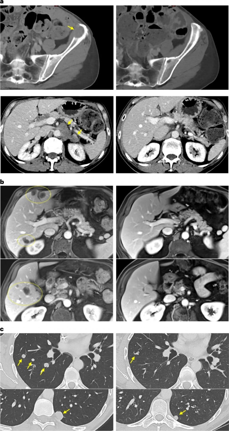 TIL细胞疗法治疗胰腺导管癌的效果