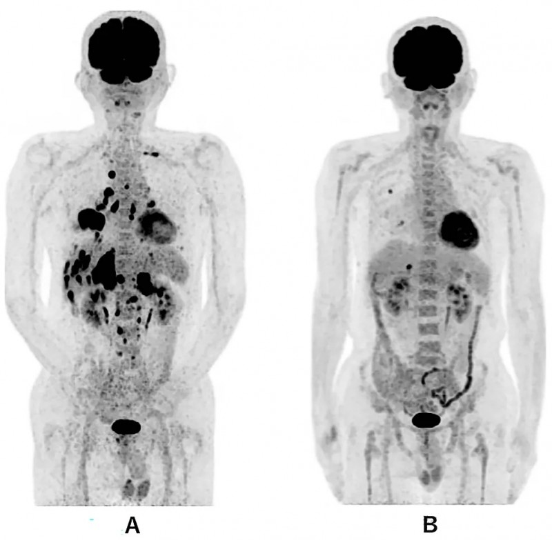 WT1-DC疫苗联合化疗治疗肺癌全身PET-CT的对比