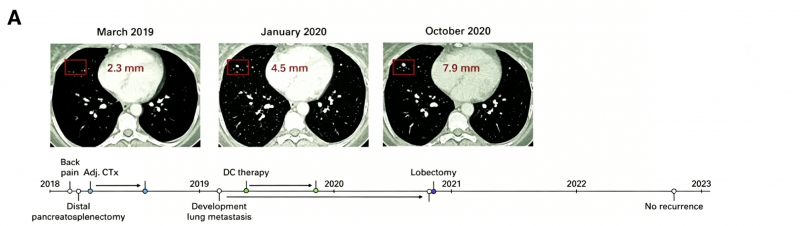 难治的稀有突变型就要用“特效药”！我国自主研发JMT-101再战非小细胞肺癌