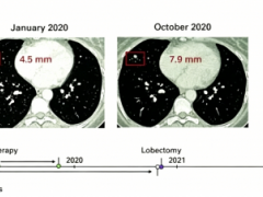 “手术成功”不等于万事大吉，新型癌症疫苗帮患者度过复发“双高峰”